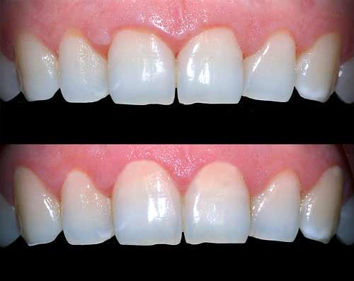Gingivectomy