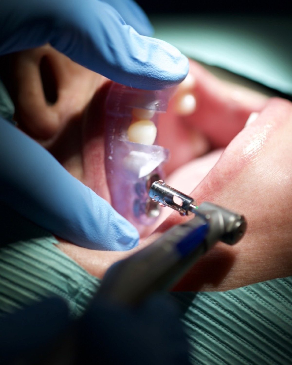 A surgical guide seated in the mouth with the drill entering a guided sleeve.