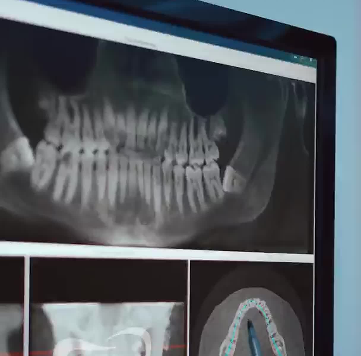 Three-dimensional DICOM scan reviewed on screen with the nerve canal traced.