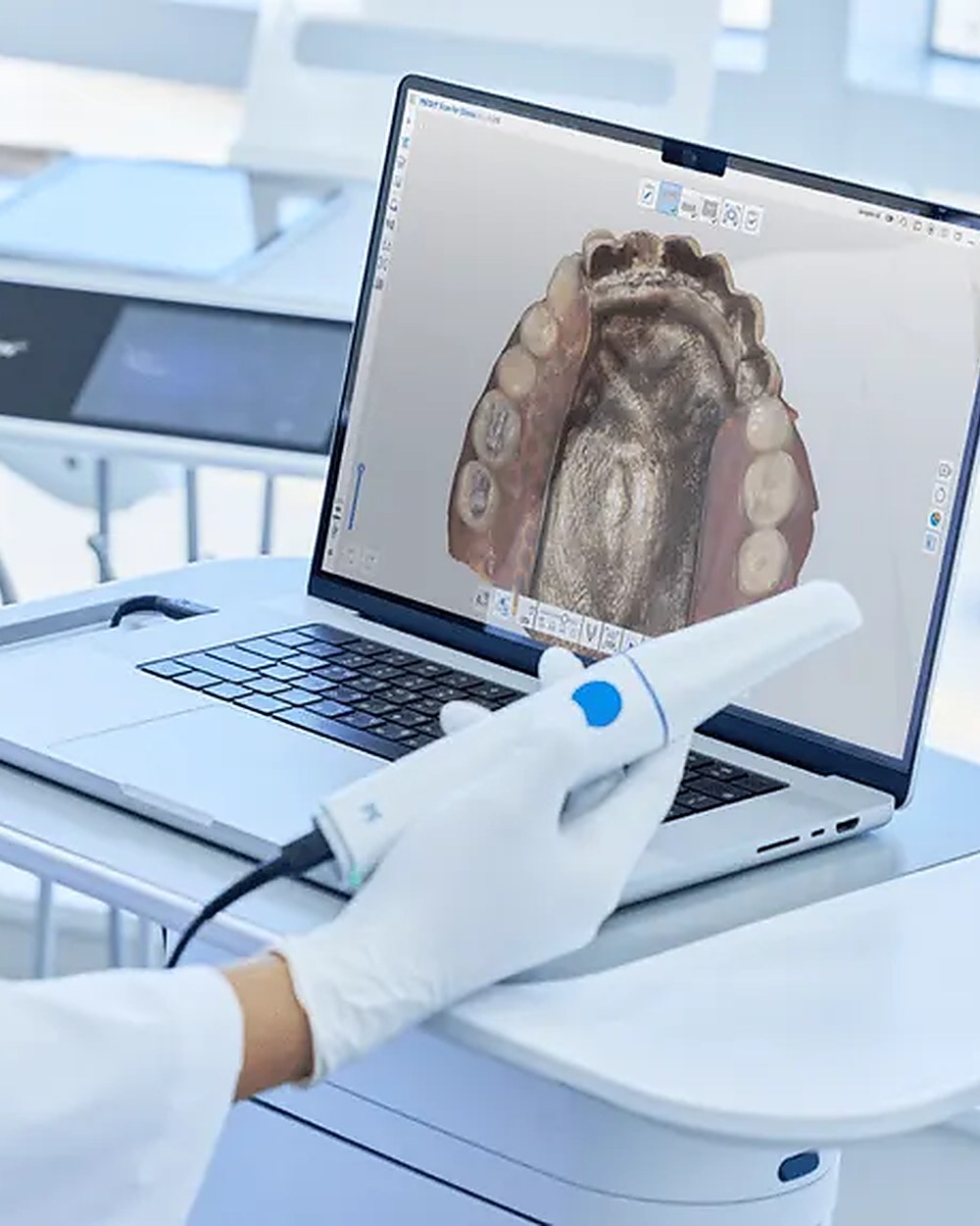 An intraoral scanner in hand with the digital impression building on screen.