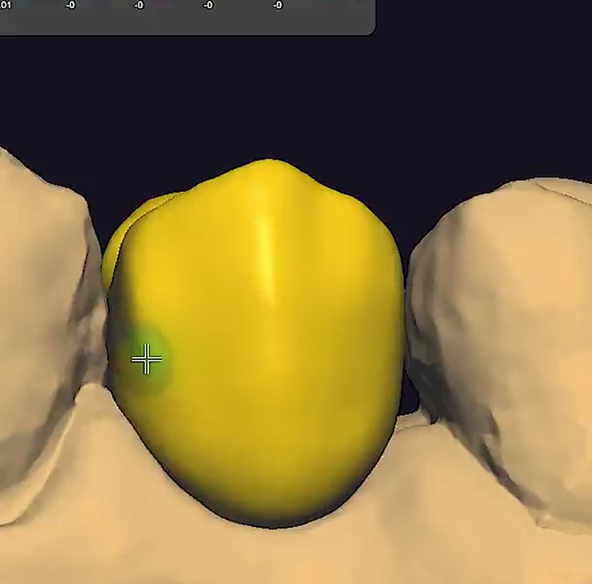Digital restoration designed on intraoral scan data.