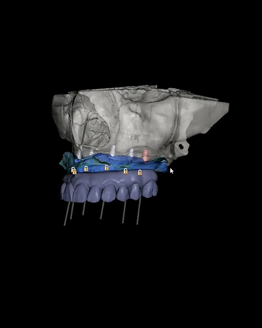 A restoration designed tooth by tooth over the segmented arch.