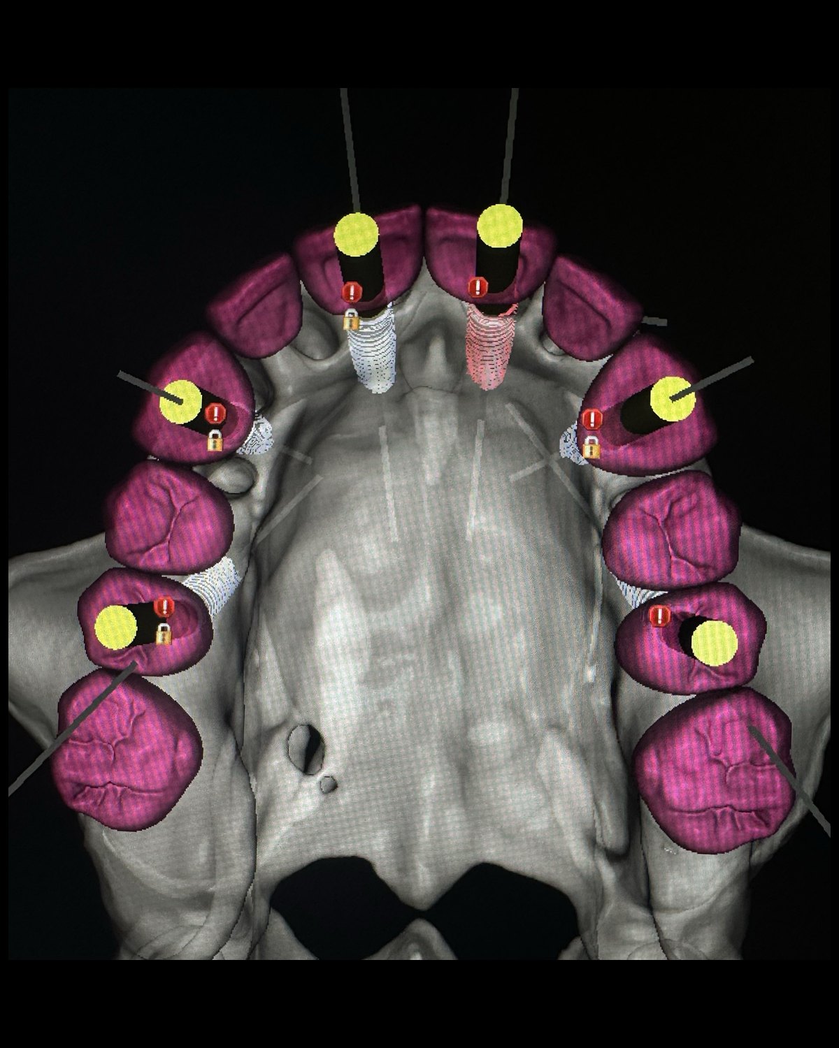 A segmented maxilla with implant positions driven by the planned prosthesis.