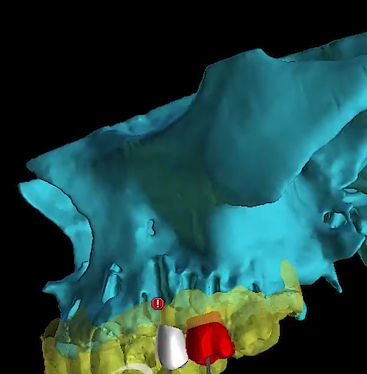 Segmented maxilla and arch prepared for implant planning.