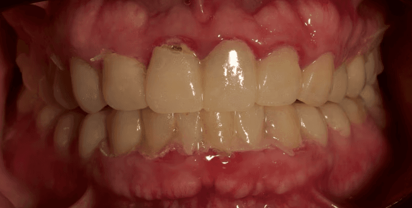 The same mouth wearing the mock-up: the digital design transferred to resin and tried in, before any definitive work