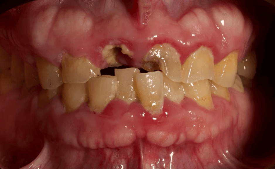 Before treatment: worn and fractured upper front teeth