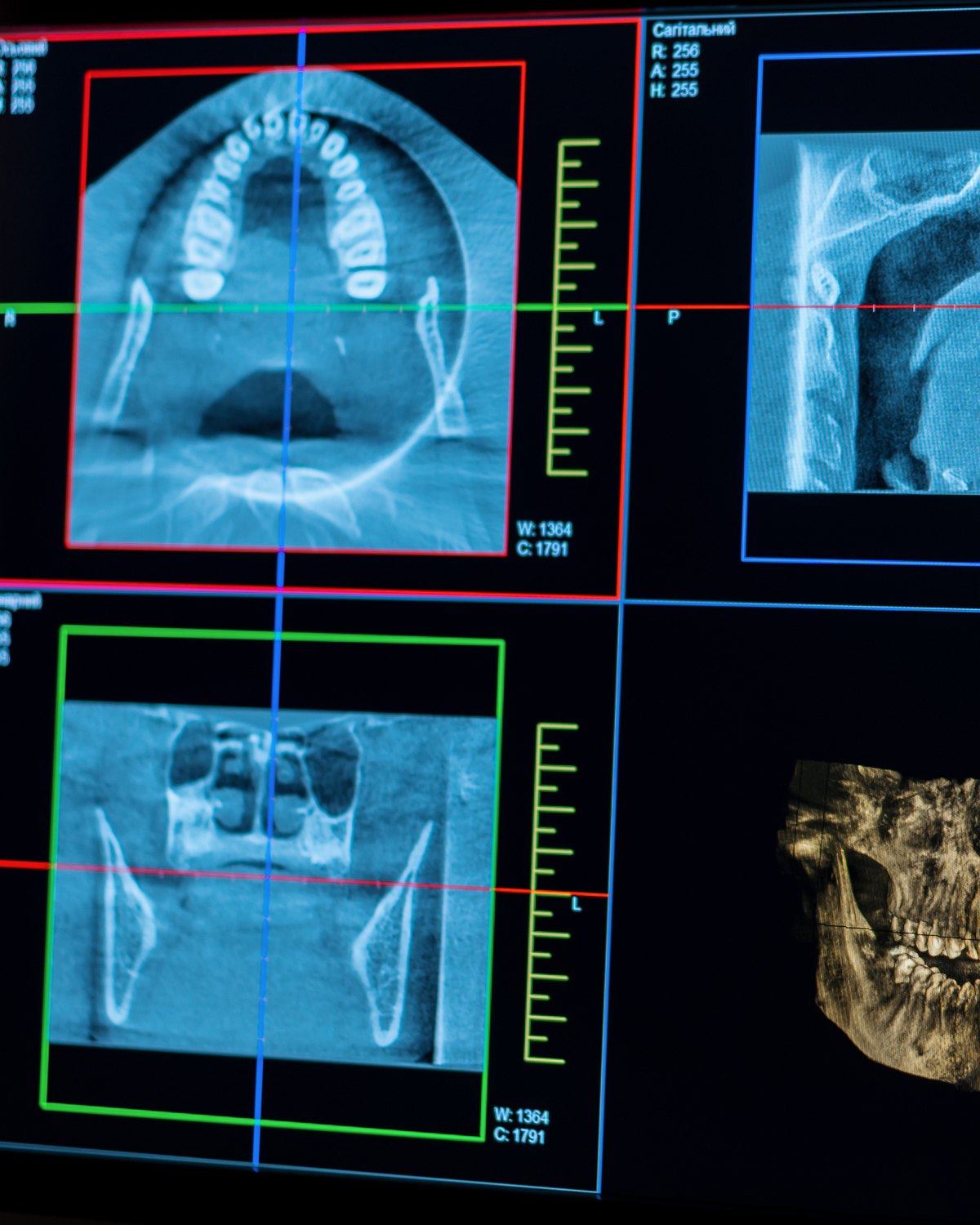 A CBCT viewer showing axial, sagittal and coronal slices beside a three-dimensional reconstruction of the jaw.